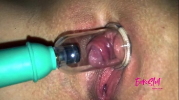 Аномальное развитие клитора